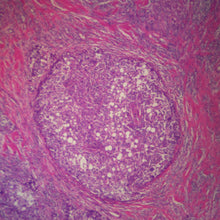 Load image into Gallery viewer, Prepared Microscope Slide, Human Breast, Adenocarcinoma, H&E