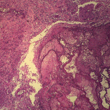 Load image into Gallery viewer, Prepared Microscope Slide, Human Lung, Metastatic Carcinoma (Cancer), H&E