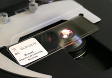 Load image into Gallery viewer, Prepared Microscope Slide, Human Breast, Adenocarcinoma, H&amp;E